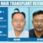 Hair Transplant Result After 12 Month