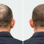 Best Hair Transplant Surgeons in Riyadh: A Detailed Review