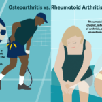 Osteoarthritis