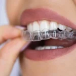 Invisalign Köln: Kosten, Ablauf und was Sie wissen müssen