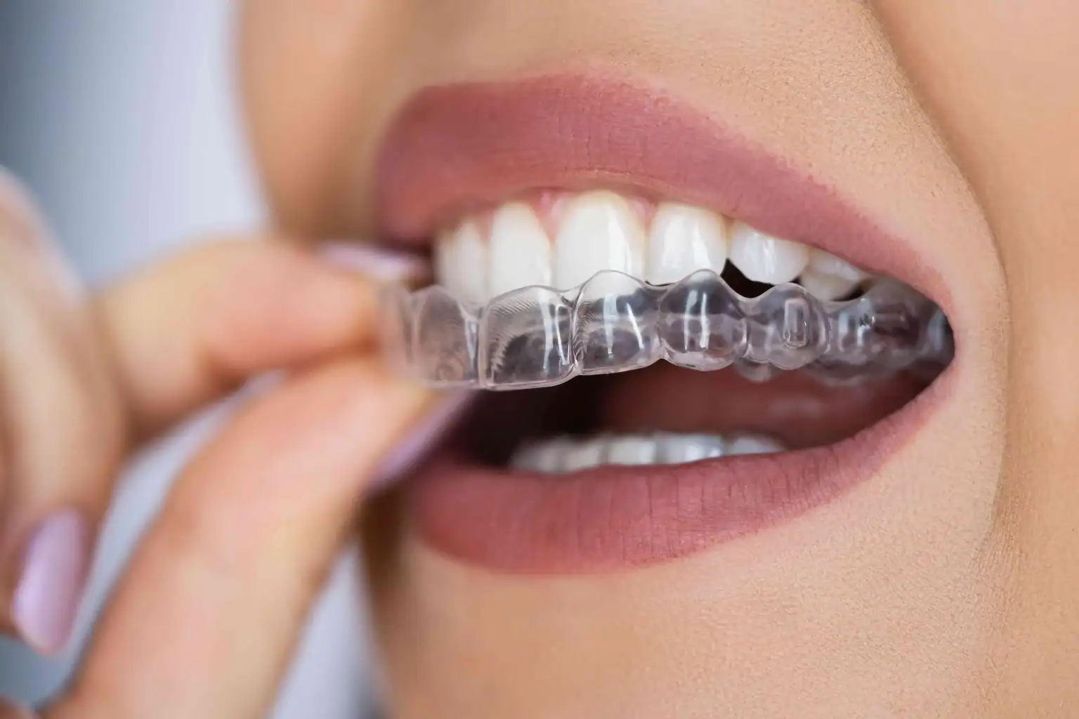 Invisalign Köln: Kosten, Ablauf und was Sie wissen müssen