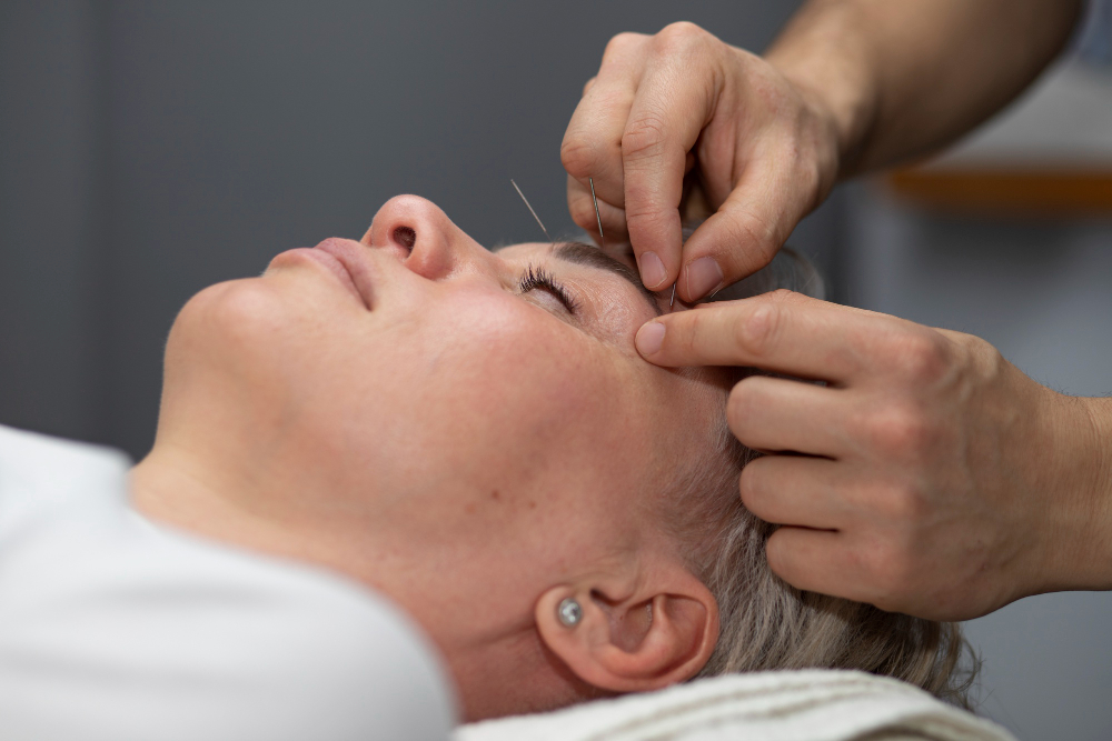 face lifting acupuncture west island