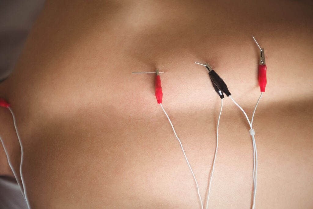 Electro Acupuncture: How Electro Stimulation Enhances Traditional Acupuncture