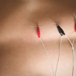 Electro Acupuncture: How Electro Stimulation Enhances Traditional Acupuncture