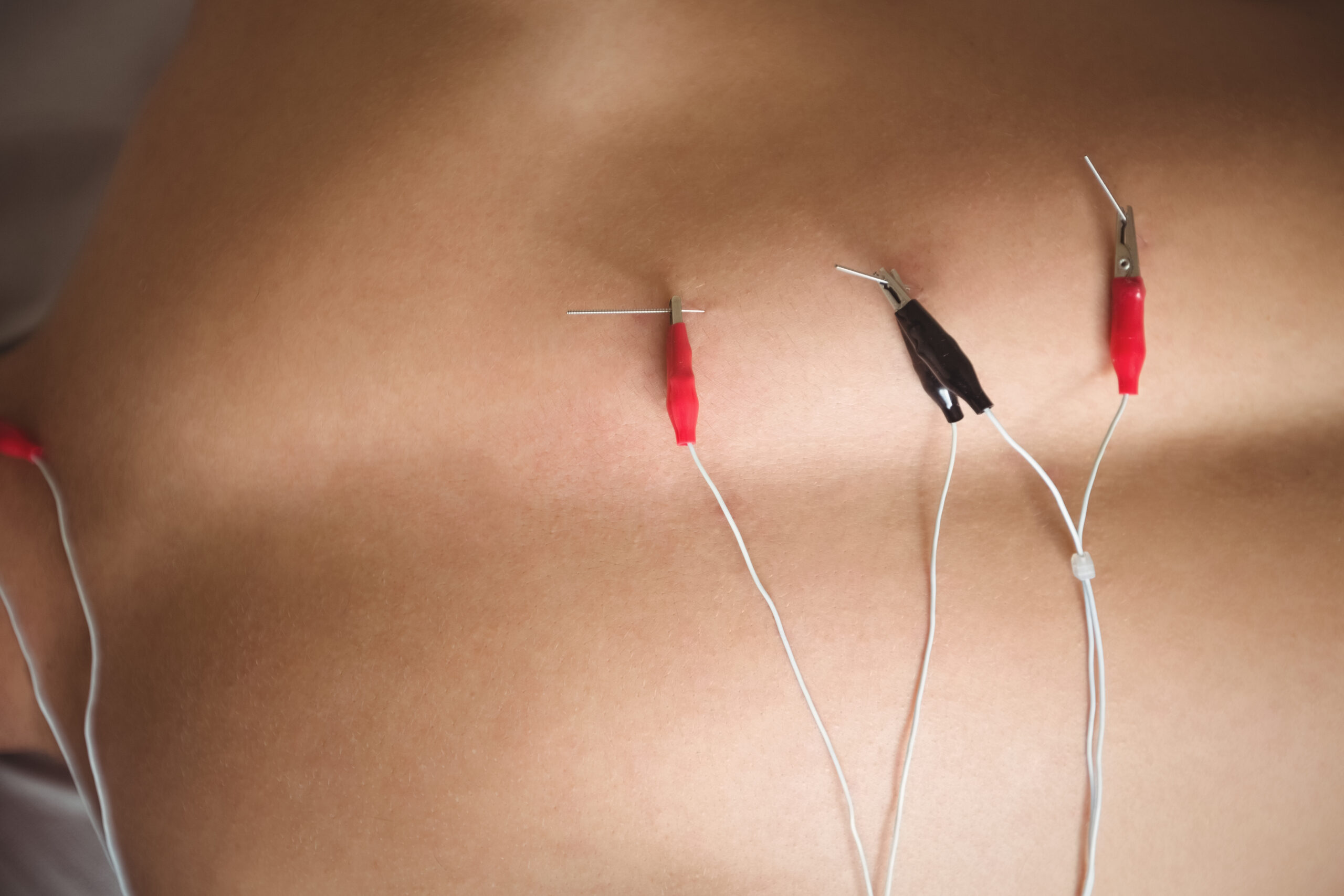 Electro Acupuncture: How Electro Stimulation Enhances Traditional Acupuncture