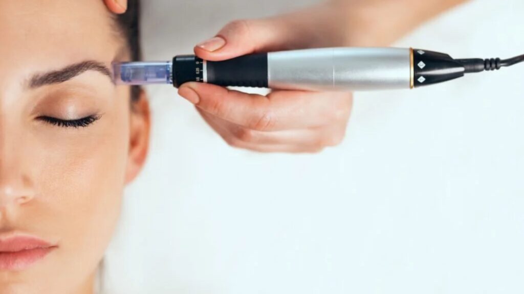 Is RF Microneedling Treatment is right? What to Know First