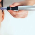 Is RF Microneedling Treatment is right? What to Know First